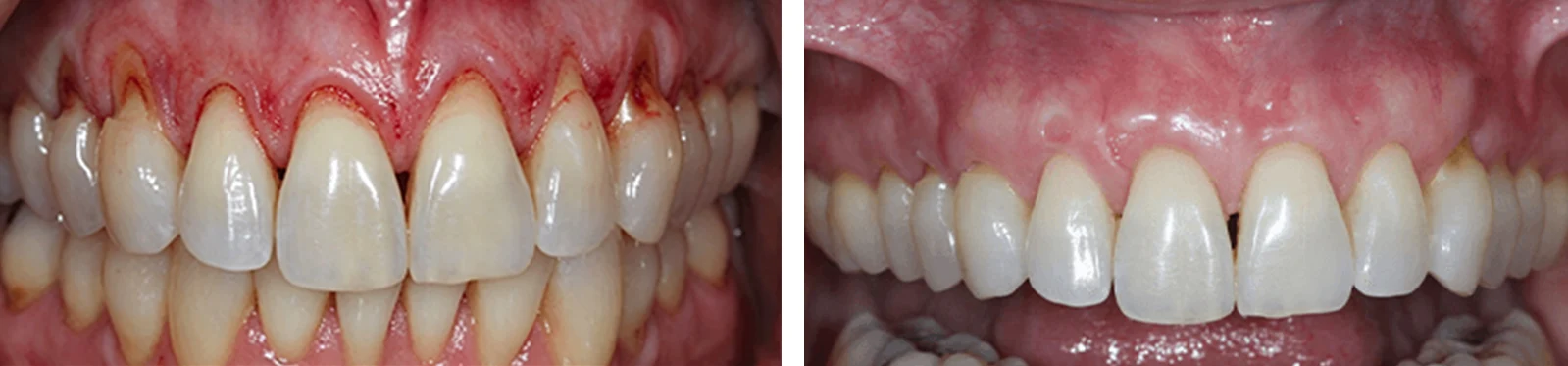 GumRevive Periodontal Repair Gel