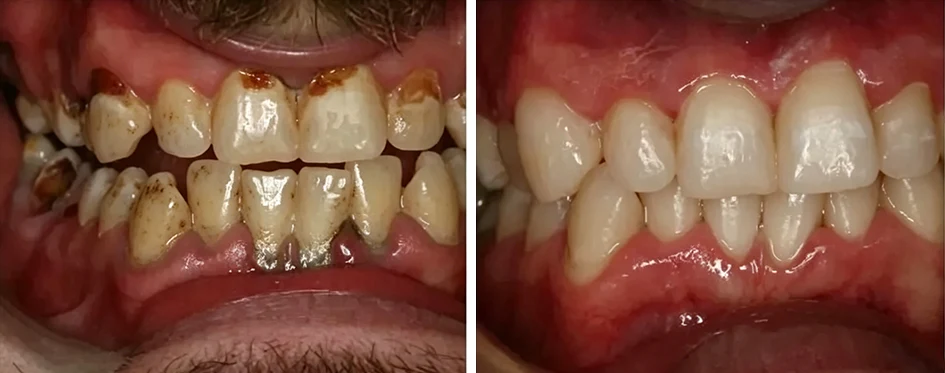 GumRevive Periodontal Repair Gel