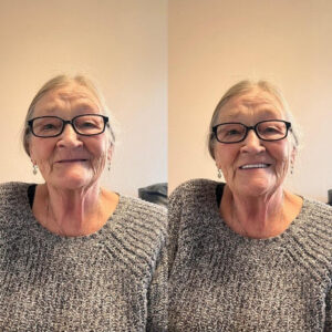 BQYOOM® DentoFuse Thermo-Adaptive TPE Dentures