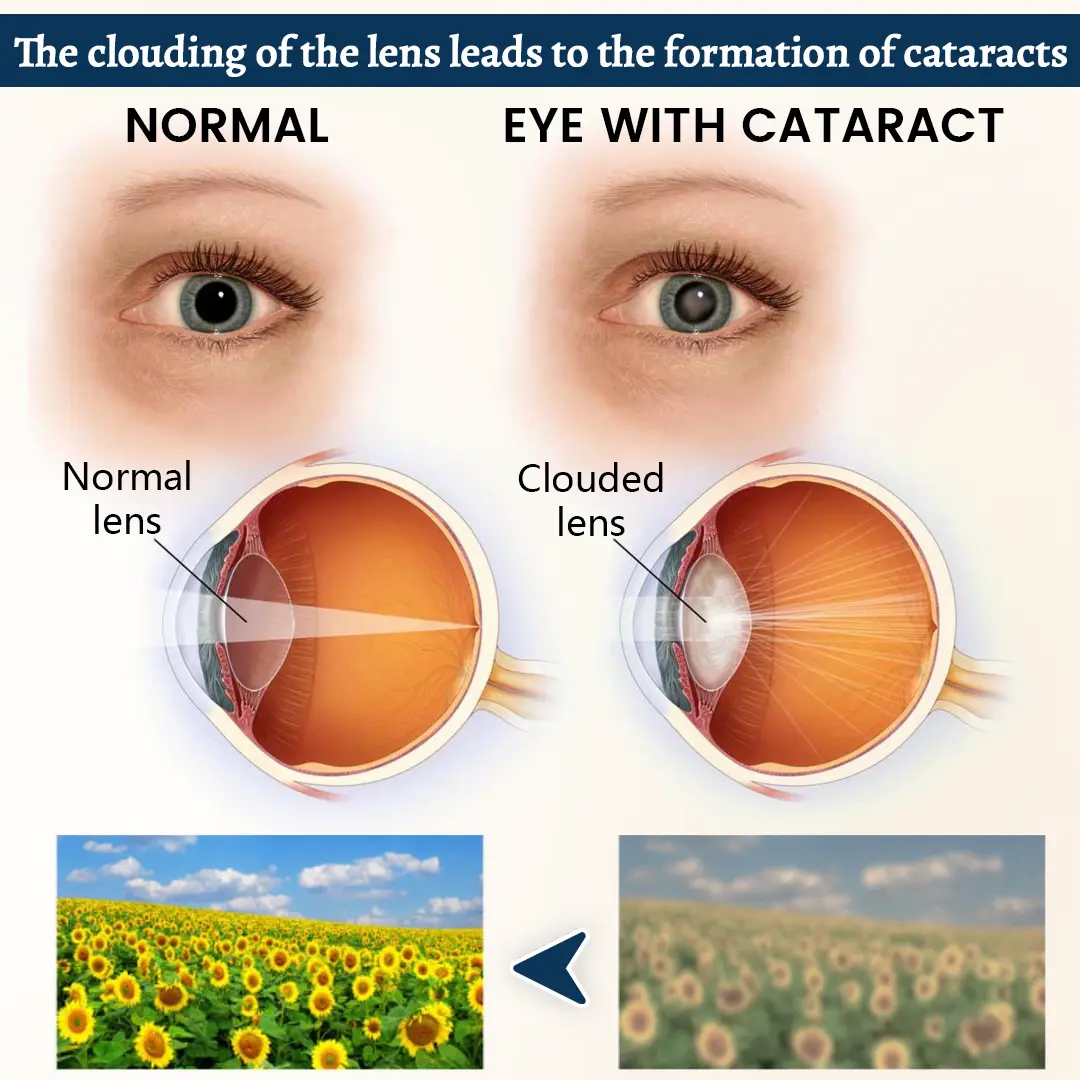 QIAWI® VisionFusion Support Eye Patch