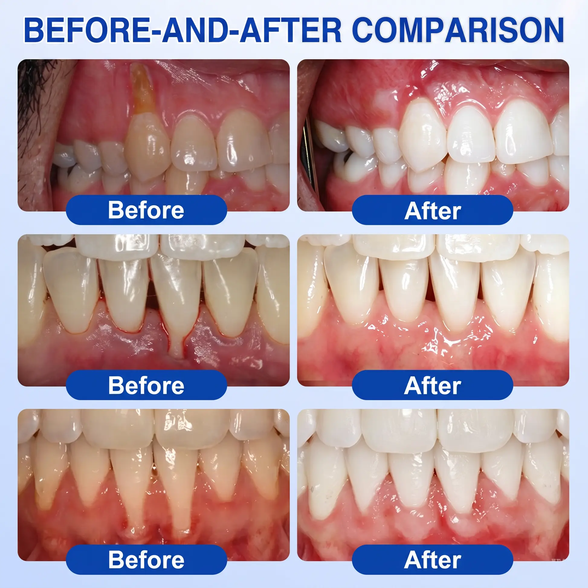 SOLAROZA® GumRevive Periodontal Repair Gel