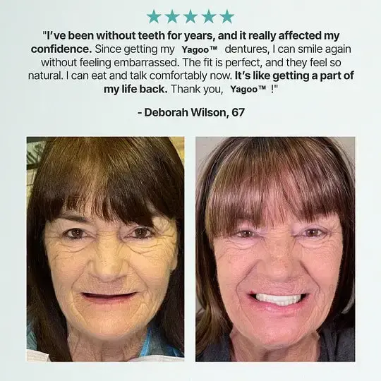 Yagoo™ Custom Custom-Fit Full Functional Dentures