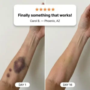 💥75K+ SOLD- TopSpire® Bruise Repair & Skin-Strengthening Cream