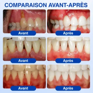 Glimmerly® Gel de Réparation Parodontale GumRevive