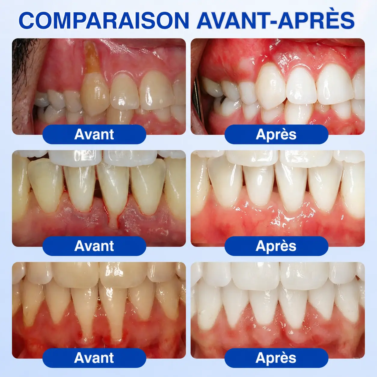 Glimmerly® Gel de Réparation Parodontale GumRevive