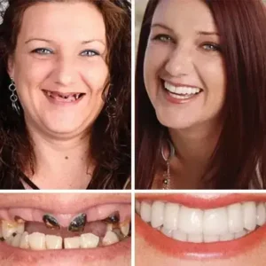 HazyGalaxy™ Functional Dentures