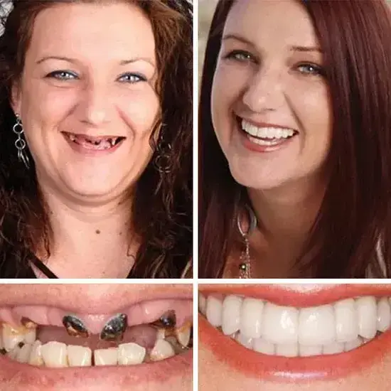 HazyGalaxy™ Functional Dentures
