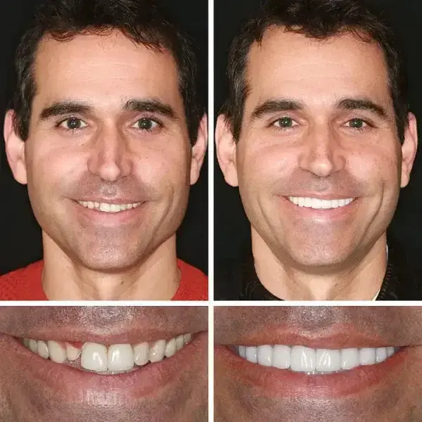 Heaceitr Full Denture Set