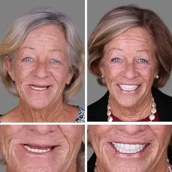Heaceitr Full Denture Set