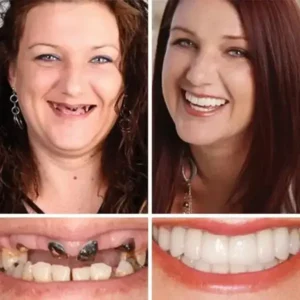 Heaceitr Full Denture Set
