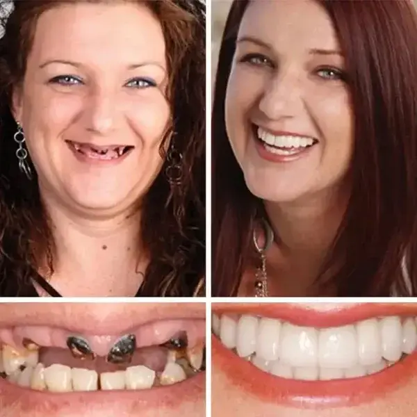 Heaceitr Full Denture Set
