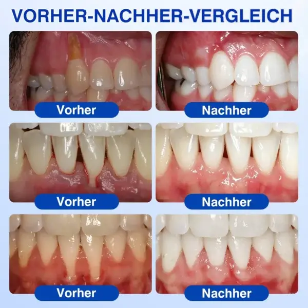 Luxarise® GumRevive Parodontal-Reparaturgel