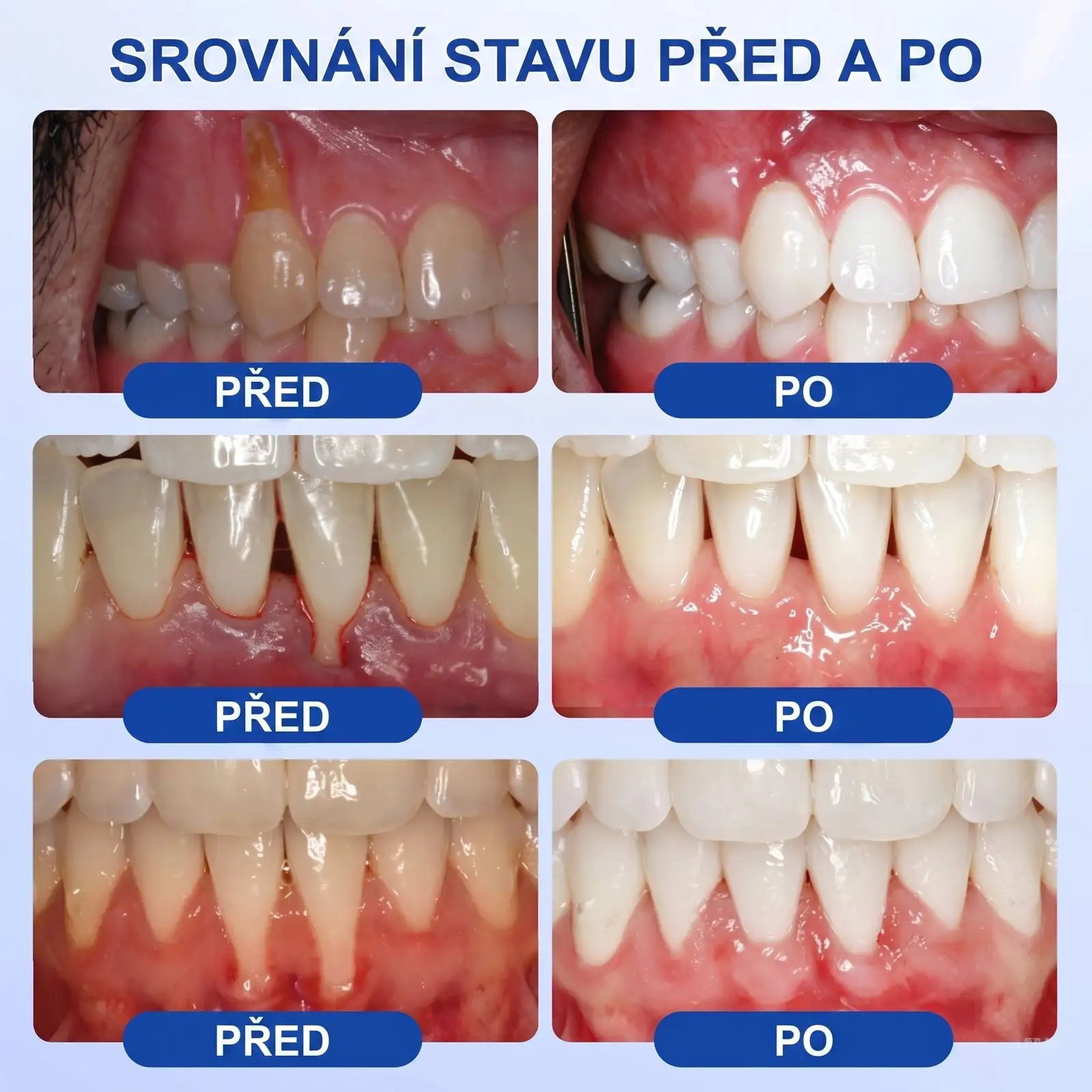 PureShade® GumRevive – Regenerace dásní