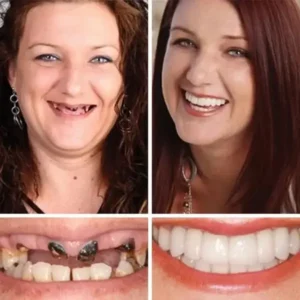 Suction-Fit Denture Set