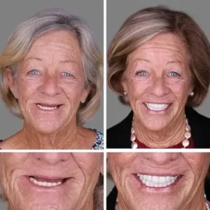 Suction-Fit Denture Set
