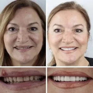 Suction-Fit Denture Set