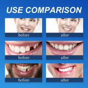 Suction-Fit Denture Set