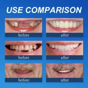 Suction-Fit Denture Set